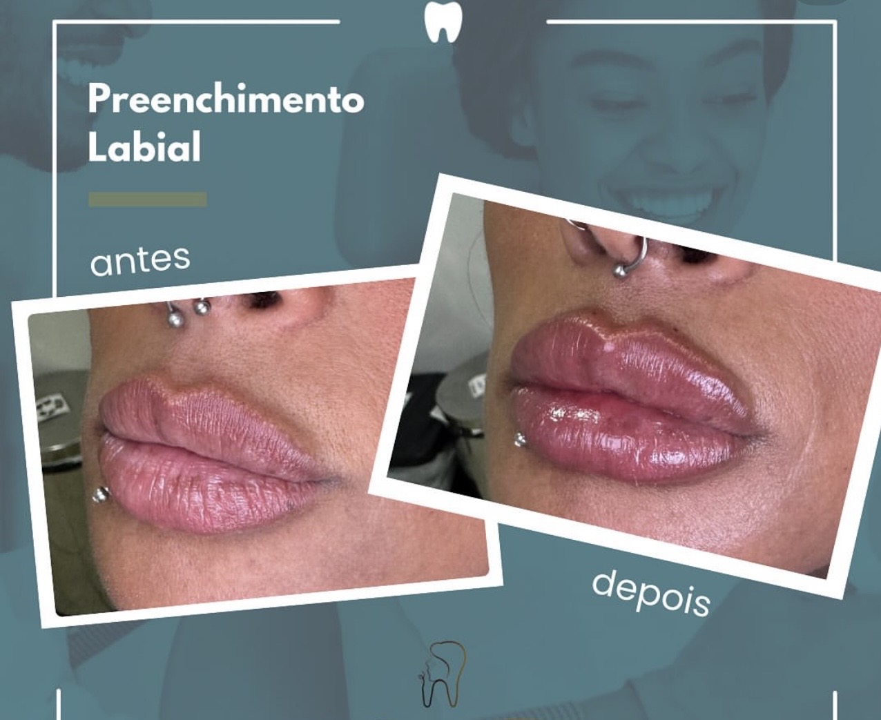 Resultado de transformação dental 5
