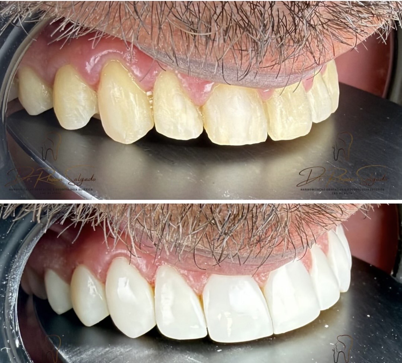 Resultado de transformação dental 2