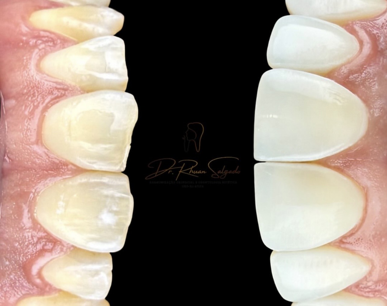 Resultado de transformação dental 4