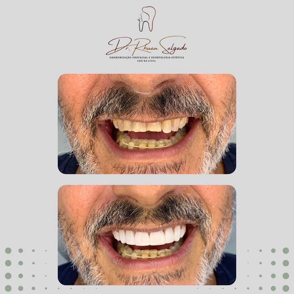 Resultado de transformação dental 1