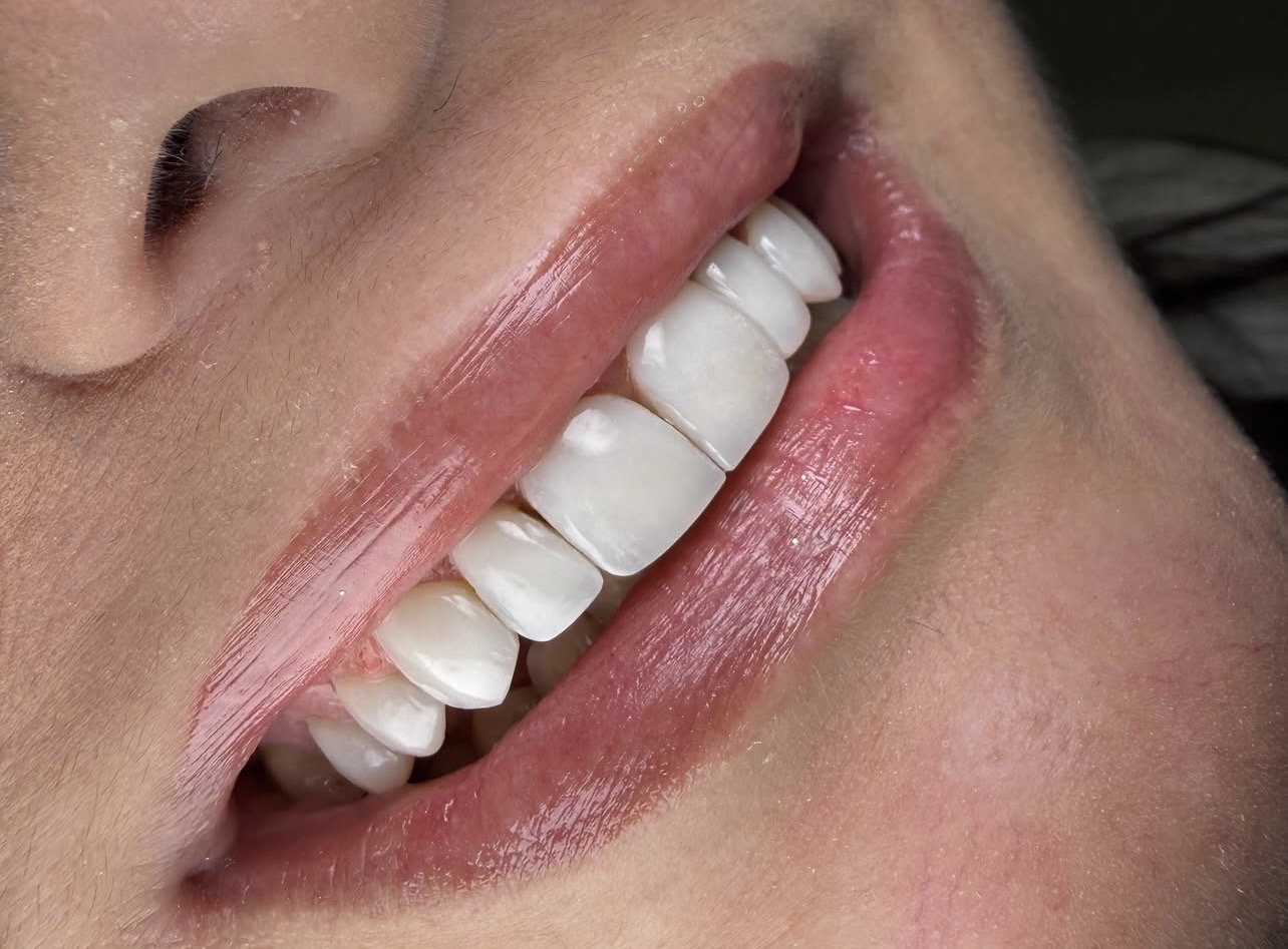 Resultado de transformação dental 3